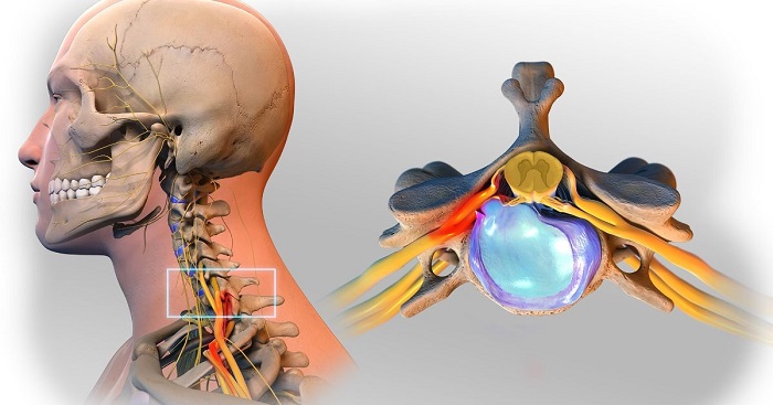 دیسک گردن علائم، علت و درمان آن با طب فیزیکی