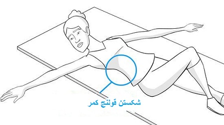 شکستن قولنج کمر