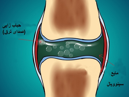 چرا دچار قولنج کمر می‌شویم